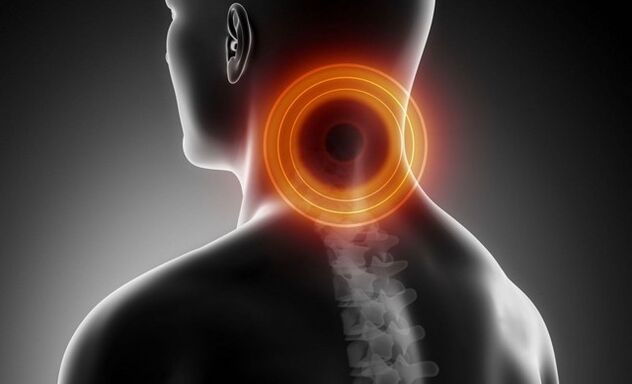 Cervicalgie avec ostéochondrose cervicale
